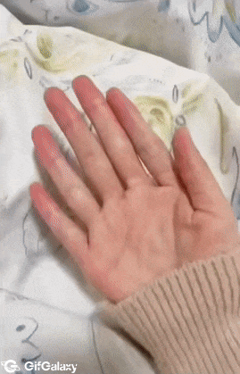 Hand with six fingers